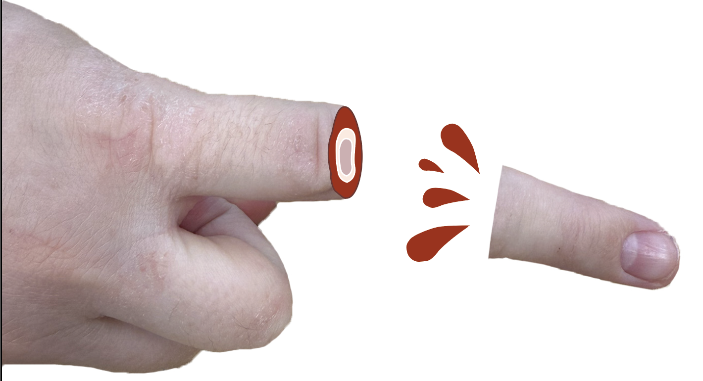 finger fell off and is bleeding